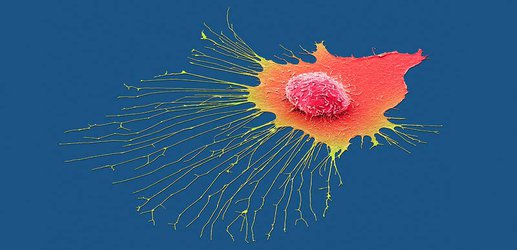 Breast cancer spreads through the body in just two or three waves