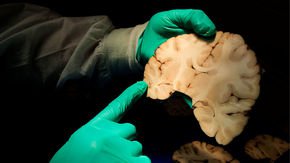 Even if you don’t play contact sports, you could develop signs of traumatic brain injury