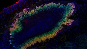 Ultrasound can ‘see’ when tumor cells turn genes on and off