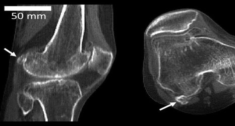 Region, age, and sex decide who gets arthritis-linked ‘fabella’ knee bone