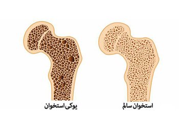پیشگیری و درمان بیماری پوکی استخوان بانوان با ورزش