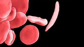 Update: FDA issues speedy approval of innovative sickle cell drug