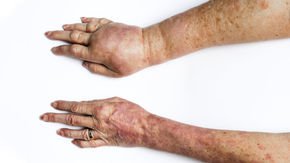 Lymph vessels on a chip reveal possible new drug target for lymphedema