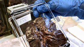 Measles may have emerged when large cities rose, 1500 years earlier than thought