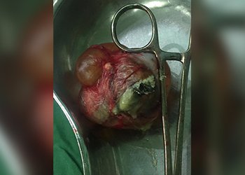 جراحی موفق توده تخمدان در بیمارستان کنگان انجام شد