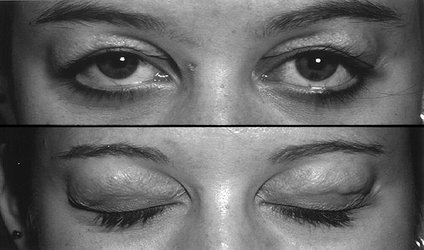 با تست ابداعی چشم پزشک ایرانی میسر شد: تشخیص افتادگی غده اشکی در افراد با پف پلک