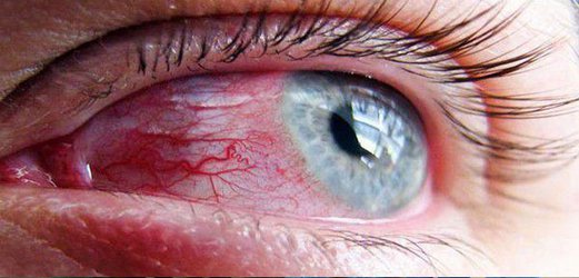 التهاب چشم هم می تواند از نشانه های تهاجم کووید ۱۹ باشد