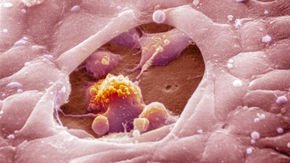 On-off dosing of cancer drugs does not help melanoma patients