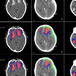 AI successfully used to identify different types of brain injuries