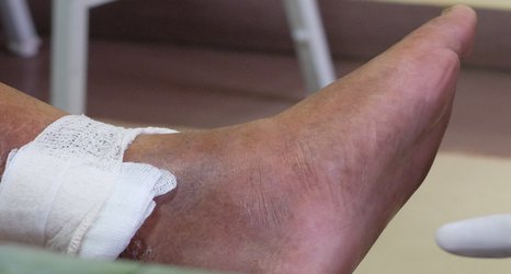 Early treatment for leg ulcers leads to better outcomes for patients