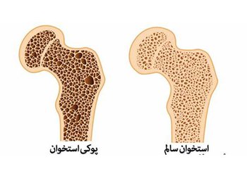 پزشک متخصص ارتوپد مرکز تخصصی ۱۷ شهریور برازجان:
شکستگی ناشی از پوکی استخوان در زنان ۴ برابر مردان است
