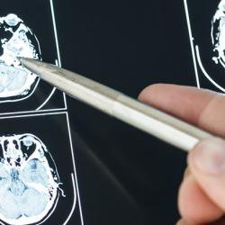 Common drug for build-up of blood following head injury worse than placebo, study finds