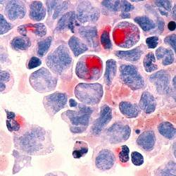 Scientists develop new class of cancer drug with potential to treat leukaemia