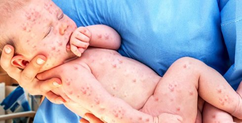 درباره بیماری سرخک چه می دانیم؟/ در روزهای کرونایی از واکسن سرخک کودکان غافل نشوید