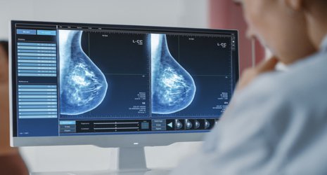 AI breast cancer screening project wins government funding for NHS trial 