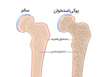 کارشناس تغذیه شبکه بهداشت و درمان دشتستان:
خطر پوکی استخوان پس از ۵۰ سالگی به‌طور قابل‌توجهی افزایش می‌یابد
