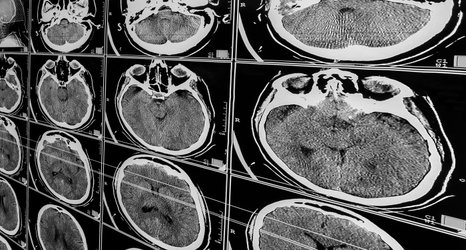 Head injuries in children linked to reduced brain size and learning difficulties