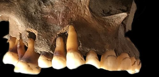 Ancient tooth DNA reveals how ‘cold sore’ herpes virus has evolved