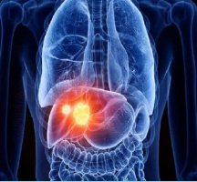 دستیابی محققان دانشگاه تهران به روش نوین درمان سرطان کبد