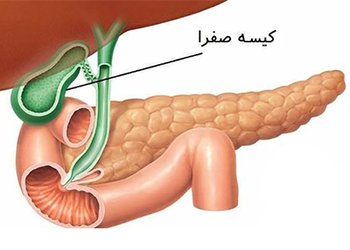 در بیمارستان کنگان انجام شد؛
جراحی عفونت حاد کیسه صفرا، تحت بی‌حسی نخاعی در بیمارستان کنگان