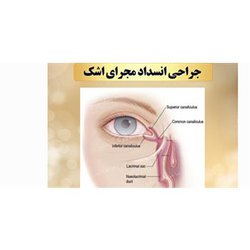مراقبتهای بعد از عمل "انسداد مجرای اشکی"