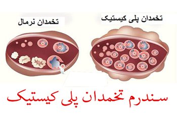 کارشناس تغذیه مرکز بهداشت شهرستان بوشهر:
رژیم غذایی متعادل در کنترل سندروم تخمدان پلی کیستیک بسیار کمک می‌کند