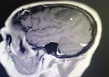انجام عمل جراحی موفقیت‌آمیز تومور گلیوم مغزی در بیمارستان شهدای خلیج‌فارس بوشهر