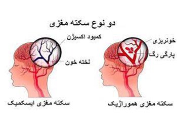 رئیس اورژانس پیش بیمارستانی و مدیریت حوادث دانشگاه علوم پزشکی بوشهر:
سکته مغزی در ساعات اولیه قابل‌درمان است/ تلاش برای پیشگیری و درمان سکته مغزی