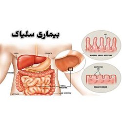 بیماری سلیاک چیست؟