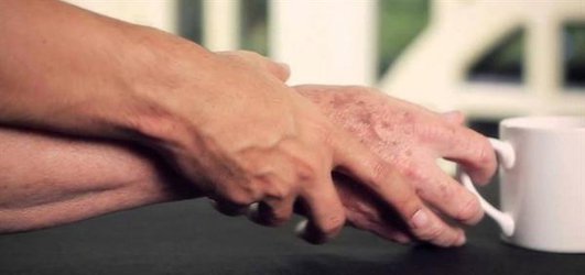 این بیماری از آدم‌ها "مجسمه" می‌سازد!