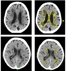 Artificial Intelligence improves stroke and dementia diagnosis in brain scans