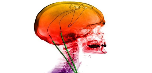 Brain implant for OCD surprisingly helps alleviate diabetes too