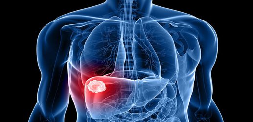 A whole new type of cancer therapy helps treat liver cancer