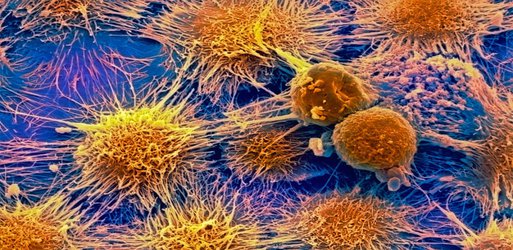 Kidney cancer spreads by pretending to be white blood cells