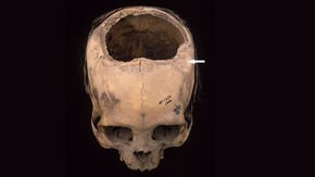 South America’s Inca civilization was better at skull surgery than Civil War doctors