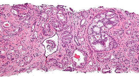 Prostate cancer ultrasound treatment as effective as surgery or radiotherapy