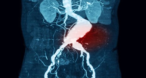 Most women ‘unlikely to benefit’ from aneurysm screening programme