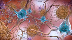 New Alzheimer’s drug shows hints of promise in inventive trial