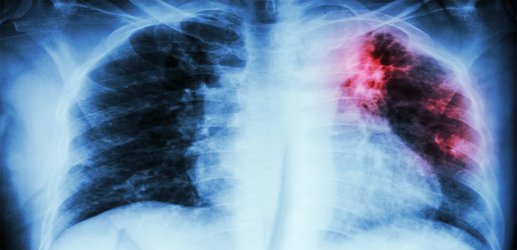 Newly-discovered type of lung cell has central role in cystic fibrosis