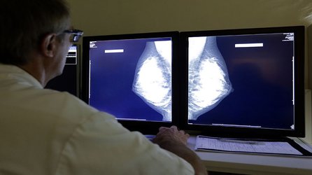 CRISPR study untangles mysterious breast-cancer gene variants