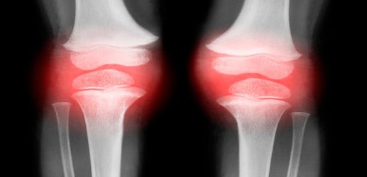 An antioxidant might lead to new therapies for bone arthritis