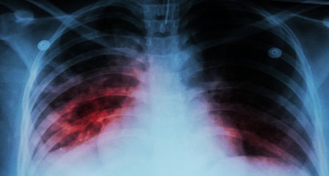 Tuberculosis genetic breakthrough may help tackle drug resistance  