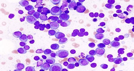 Breakthrough drug shows early promise for multiple myeloma