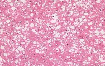 Pioneering treatment to be given to CJD patient for the first time