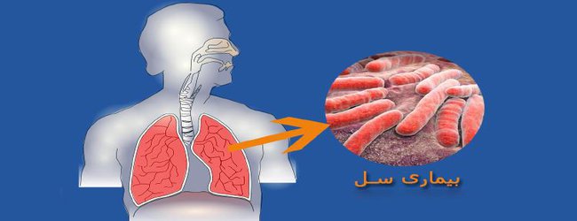 سل همچنان در لیست ۱۰ علت اول مرگ و میر در جهان قرار دارد