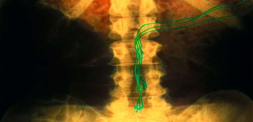 Spinal implants are getting better at reversing paralysis