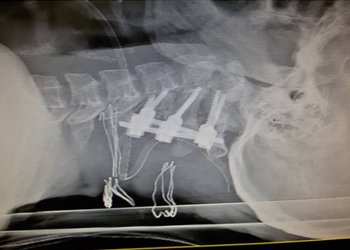 متخصص و جراح مغز و اعصاب بیمارستان شهید گنجی خبر داد:
انجام عمل ثابت کردن مهره‌های گردنی برای اولین بار در بیمارستان شهید گنجی