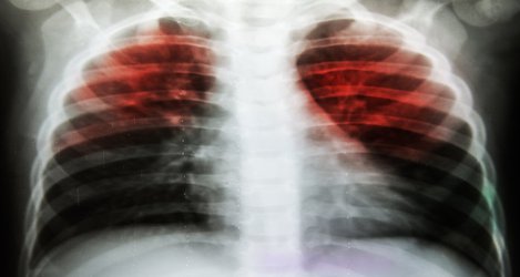 New blood tests for TB could accelerate diagnosis and save the NHS money