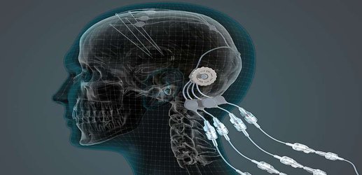 Parkinson’s drug pumped directly into brain fails to pass key tests