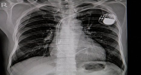 AI can improve X-ray identification of pacemakers in emergencies